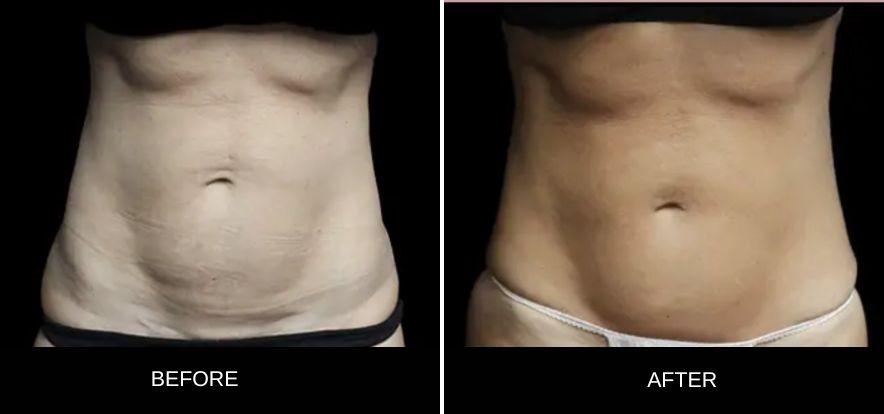 lanluma-abdomen-before-after.jpg