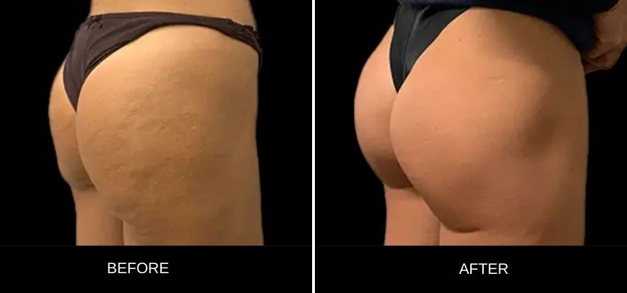 lanluma-buttocks-before-after