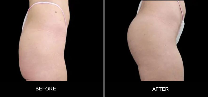 lanluma-thighs-before-after